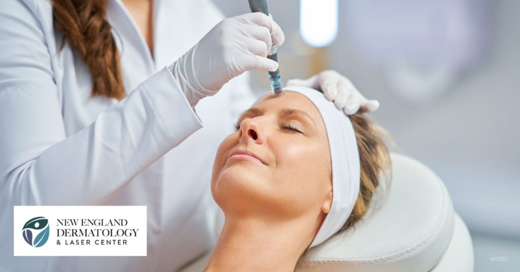 A woman getting the microneedling treatment on her face (model).