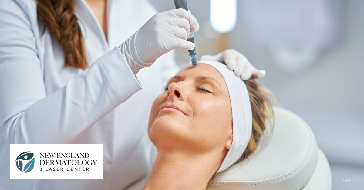 Does Microneedling Work? Get the Facts About This Treatment