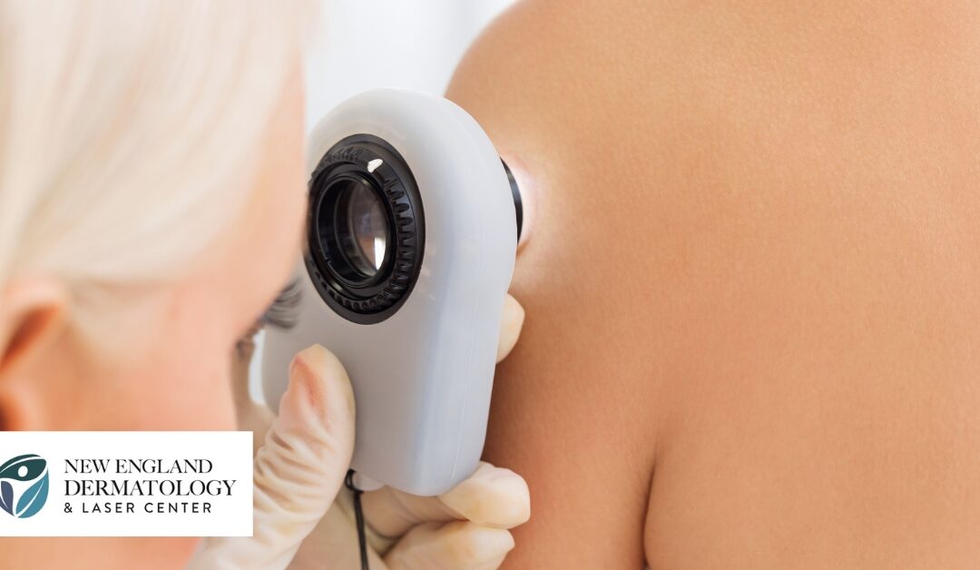 Understanding the Causes of Skin Cancer