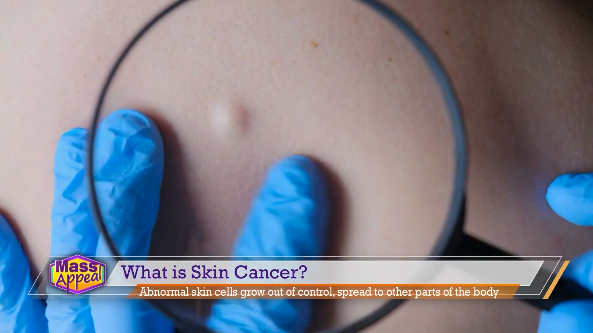Protect Yourself Against Melanoma- Dr. Glazer discusses Skin Cancer Awareness Month