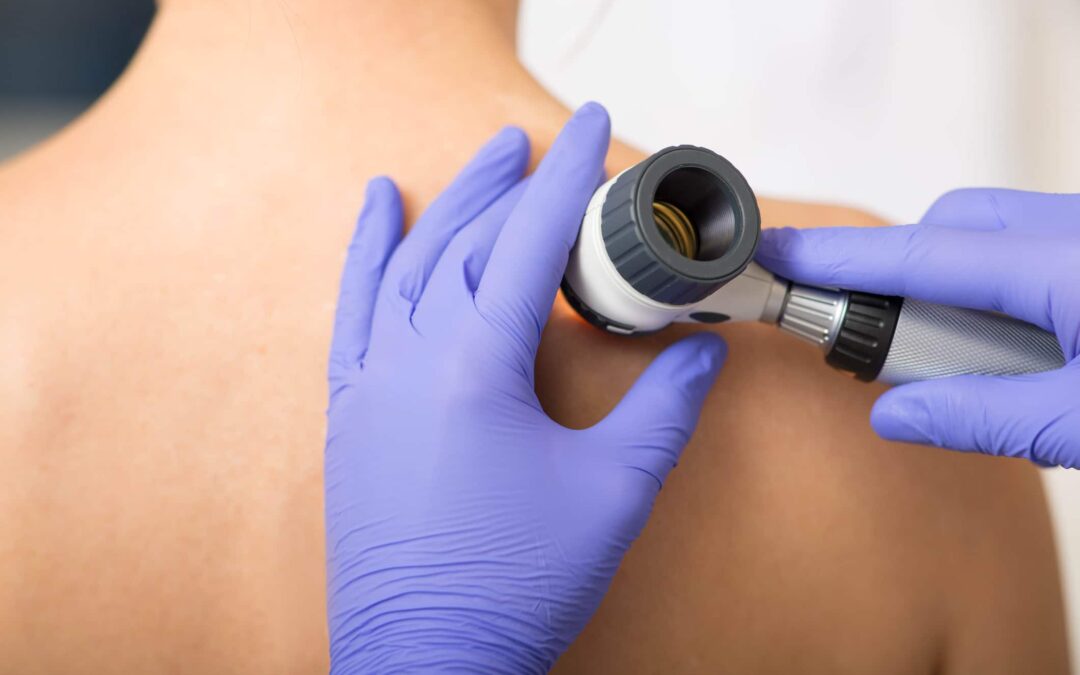 Safeguard Your Skin This Melanoma Awareness Month