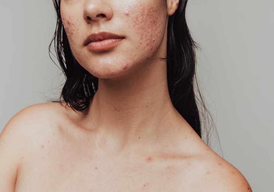 Acne Awareness Month: Dermatologist Recommendations