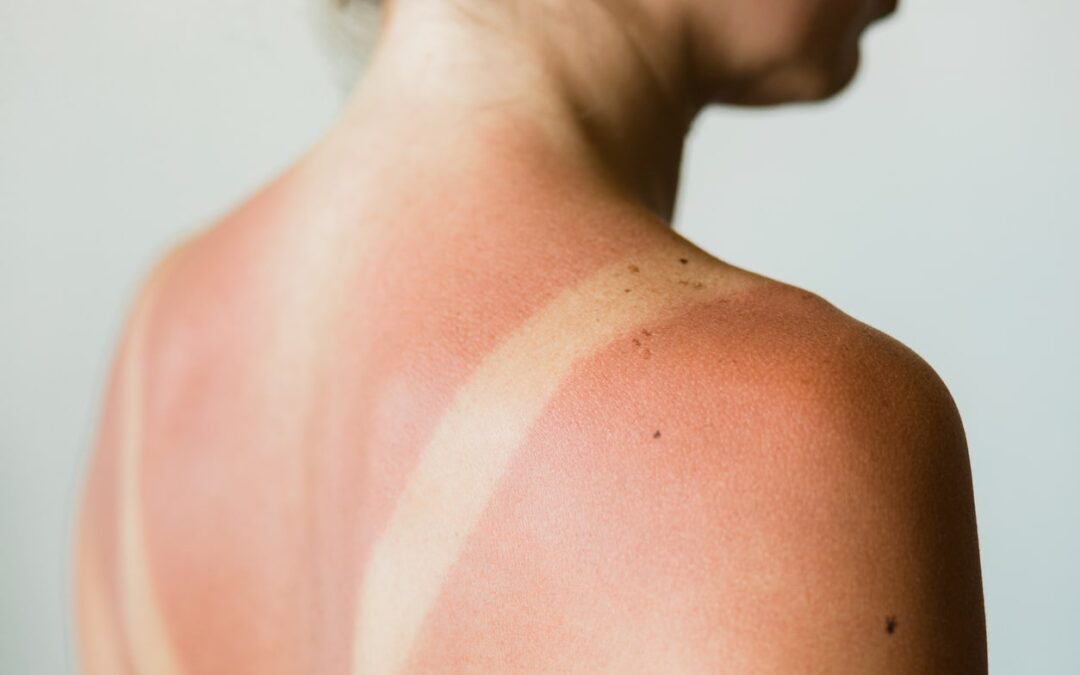 UV Awareness Month: How to Protect Your Skin from UV Damage
