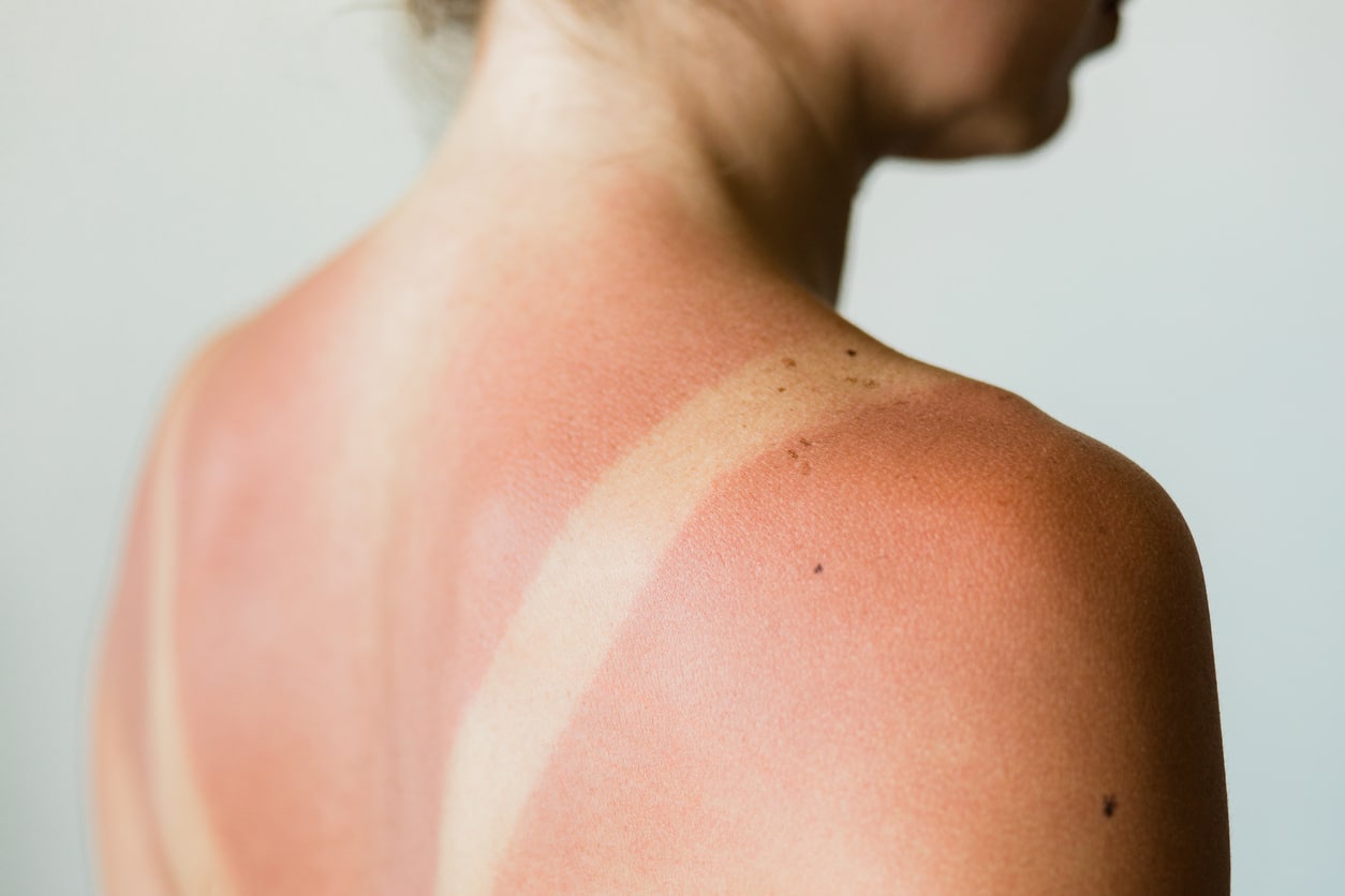 UV Awareness Month: How to Protect Your Skin from UV Damage