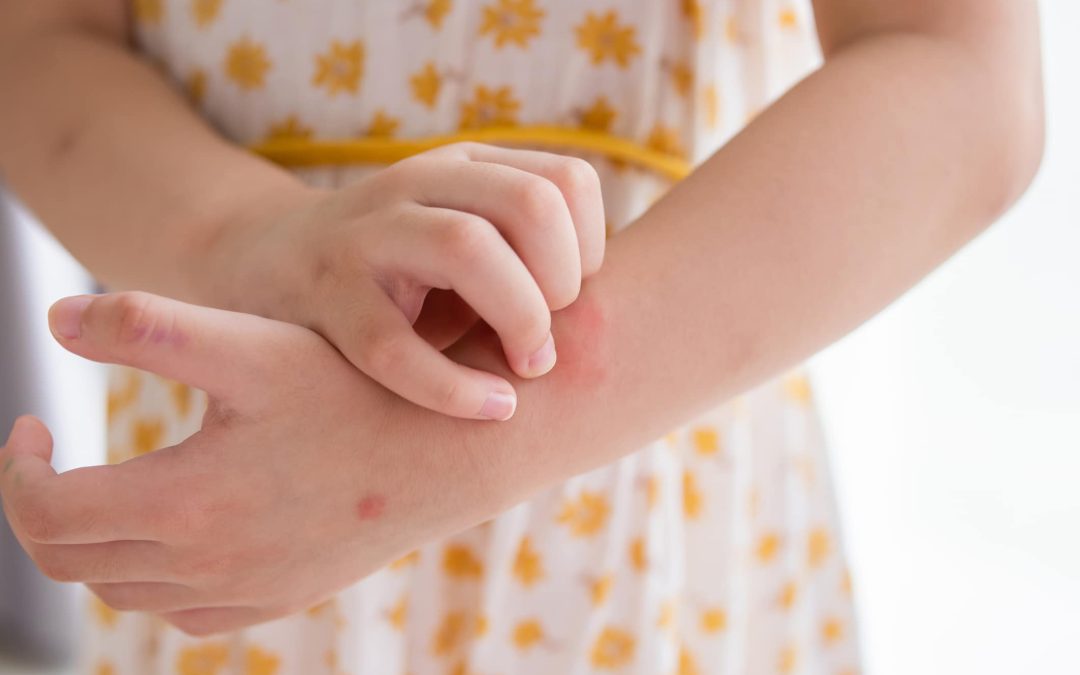 Eczema Awareness Month: Symptoms, Treatments & Considerations
