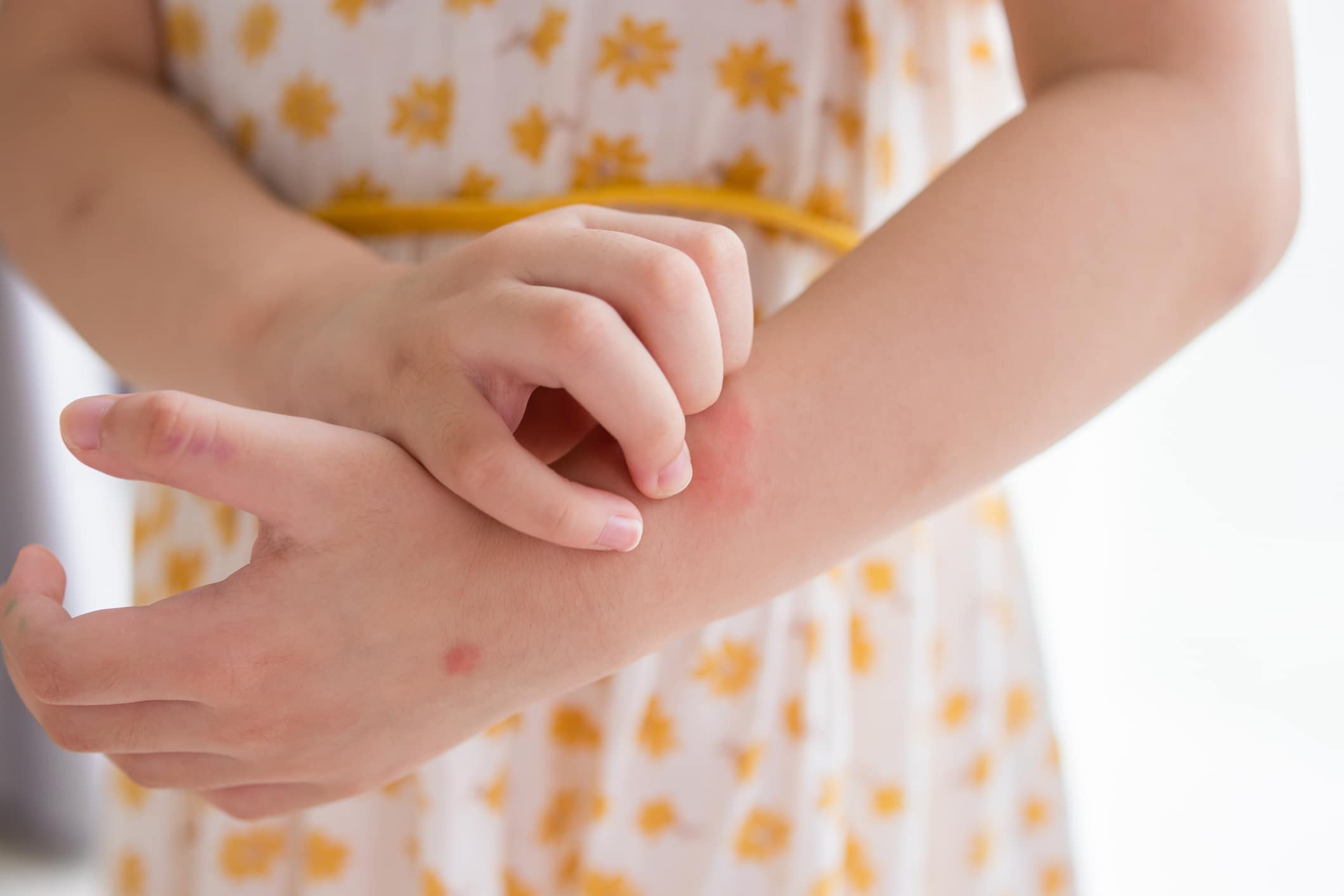 Eczema Awareness Month: Symptoms, Treatments & Considerations